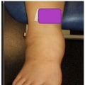 Understanding the Balgrist Score for Charcot Foot