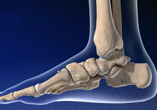 Charcot Foot: Understanding the Immediate Treatment