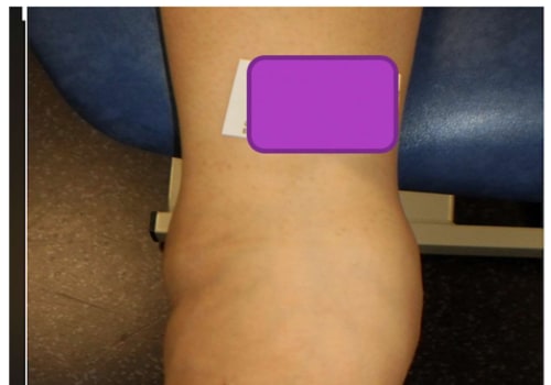 Understanding the Balgrist Score for Charcot Foot