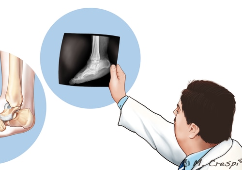 Charcot Foot: Diagnosis and Treatment Strategies