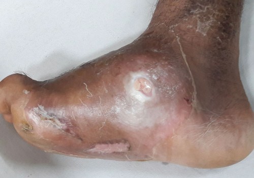 Charcot Foot: Understanding and Managing This Serious Complication of Diabetes