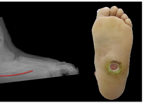 Charcot Foot: Understanding the Condition and How to Prevent It