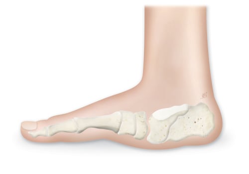 Understanding Charcot Foot: A Neurological Disease