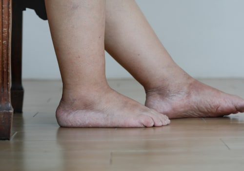 Understanding the Stages of Charcot Arthropathy