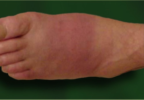 Understanding Charcot Foot Flare Ups